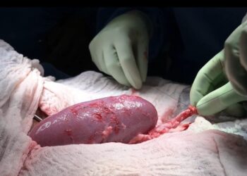 Científicos estadounidenses realizan el primer trasplante de un riñón de cerdo a un humano