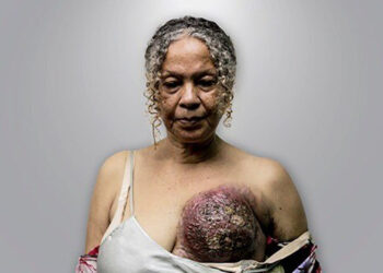 Esta es la cantidad de dinero que una mujer con cáncer de mama necesita para costear tratamiento en Venezuela