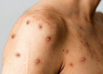 OMS advirtió a hombres homosexuales cuidarse para evitar la viruela del mono