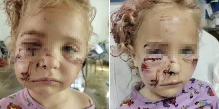 Niña de 5 años fue atacada brutalmente por un perro en Fort Lauderdale