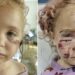 Niña de 5 años fue atacada brutalmente por un perro en Fort Lauderdale