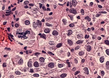 Ensayos clínicos de vacuna logran resultados alentadores en la lucha contra el cáncer de piel más letal