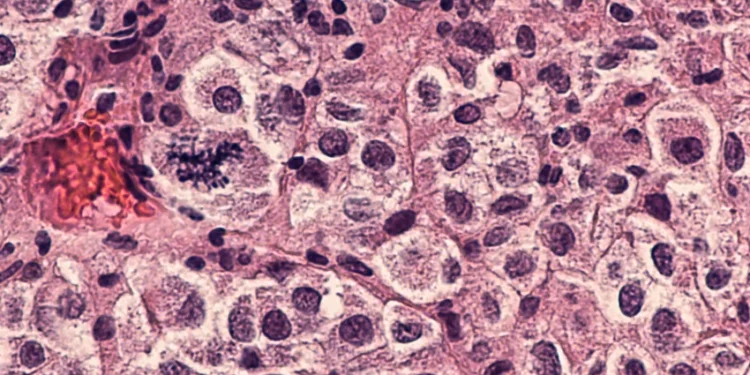 Ensayos clínicos de vacuna logran resultados alentadores en la lucha contra el cáncer de piel más letal