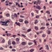 Ensayos clínicos de vacuna logran resultados alentadores en la lucha contra el cáncer de piel más letal