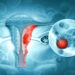 Supervivencia libre de progresión en el cáncer de ovario aumenta al añadir 2 fármacos