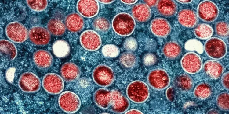 La OMS advierte que es probable que haya más casos de viruela del mono en Europa
